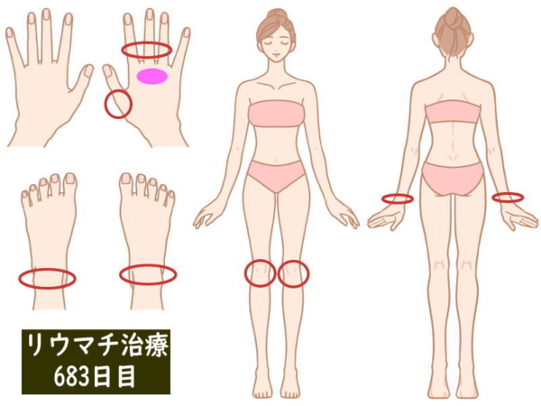 リウマチ治療683日目