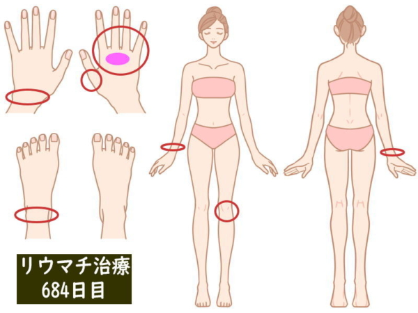 リウマチ治療684日目