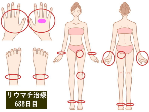 リウマチ治療688日目