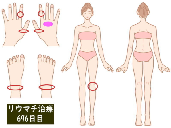 リウマチ治療696日目