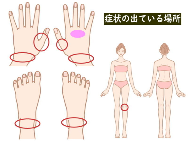 今朝のリウマチの症状の出ている場所(関節リウマチ治療744日目)
