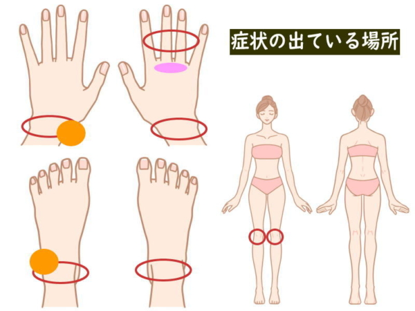 今朝のリウマチの症状の出ている場所(関節リウマチ治療748日目)