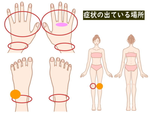今朝のリウマチの症状の出ている場所(関節リウマチ治療752日目)