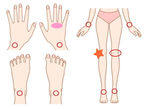 今朝のリウマチの症状の出ている場所(関節リウマチ治療768日目)